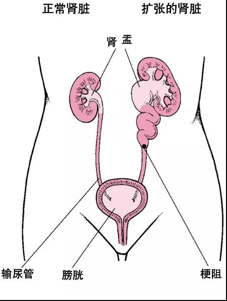 呵护肾脏,让肾脏不再"受伤"——输尿管软镜碎石术
