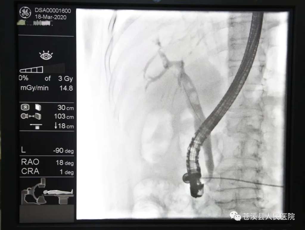 不开刀取胆总管结石——我院消化内科成功开展首例ercp est手术